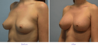 Breast Augmentation Results Nashville Breast Augmentation Results Nashville